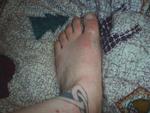 The Still's rash on my foot