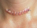 Close up 3 days after surgery--trying not to freak out about the "worm" appearance!