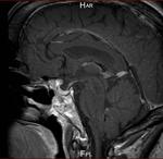 Pit MRI - post op 2008