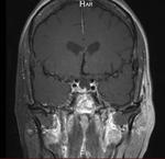 Pit MRI - post op 2008 Coronal view