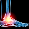 Ankle Sprains: Causes, Consequences and Cures
