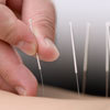 Can Acupuncture Help You Conceive?