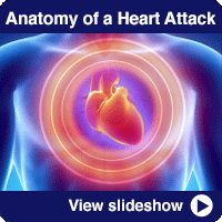 What Is a Heart Attack?