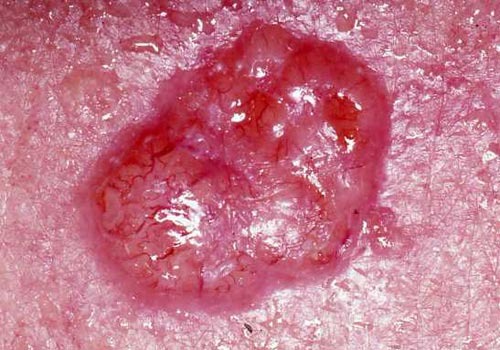 Keratinocyte Carcinoma