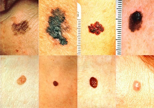 Know the ABC’s (and D’s and E’s) of Skin Cancer