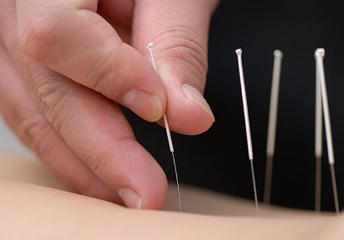 Acupuncture and Cold Laser Therapy