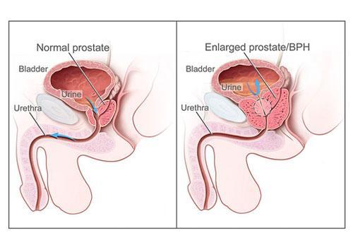 Enlarged Prostate and BPH