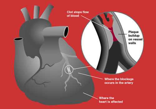 What Happens During a Heart Attack?
