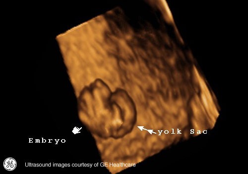 Week 6: Pregnancy Week By Week 3D Ultrasound Images