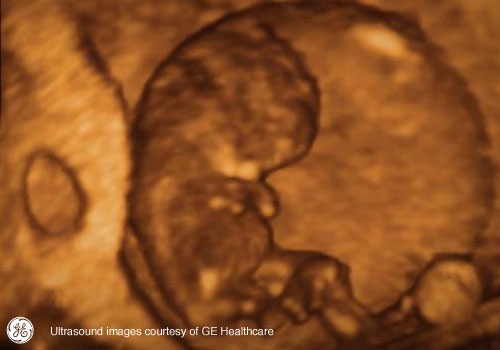 Week 9: Pregnancy Week By Week 3D Ultrasound Images