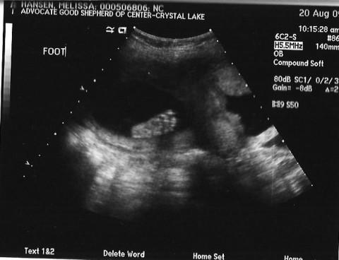 Baby foot 20 weeks
