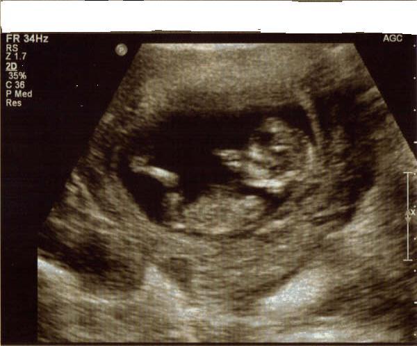 12 weeks ultrasound picture  :-)