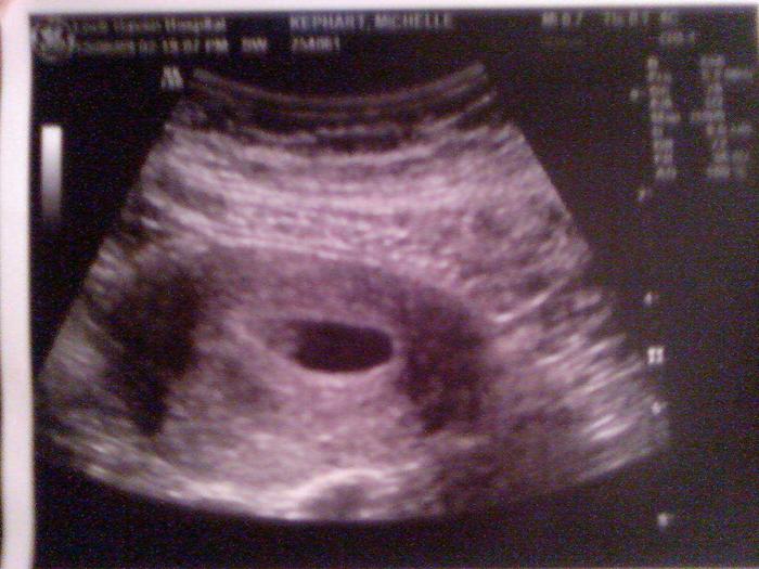 first ultrasound 7 wks