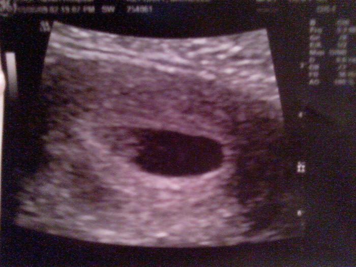 first ultrasound 7 wks