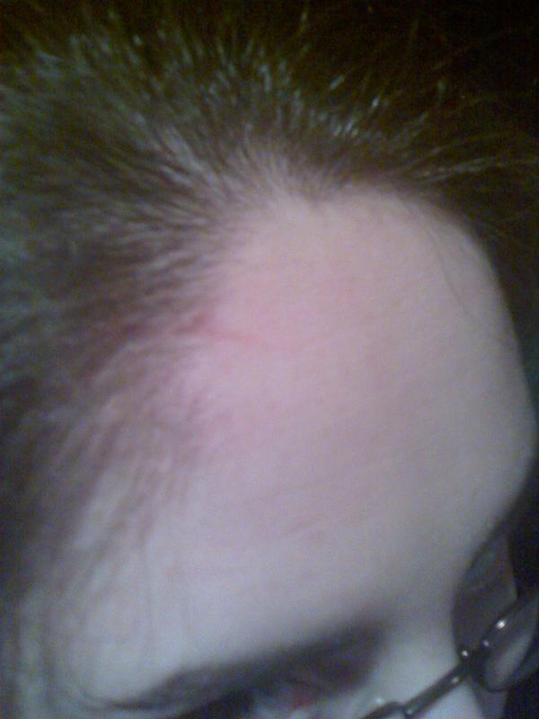 Newest head injury...  Can't really see much...