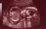 20 weeks - it's a girl!
