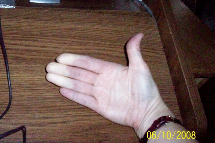 Raynaulds Syndrome on Hand