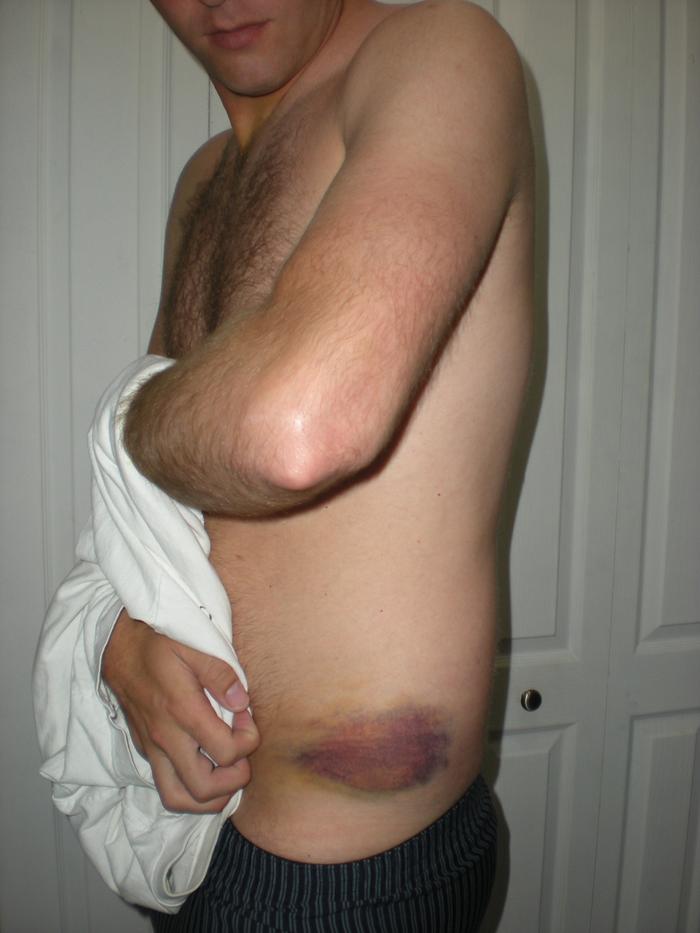 soccer injury assault. hip pointer 5 days after injury.