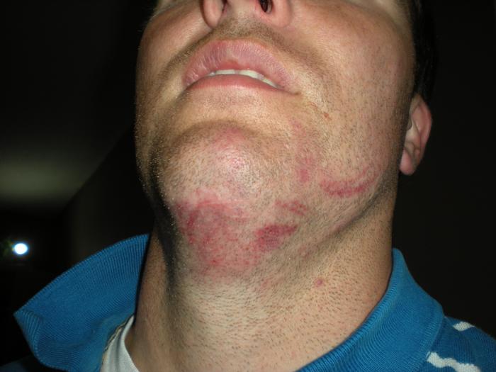 soccer injury/assault.cleat marks that night