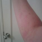 1 week of prednisone - burning hives cover right arm