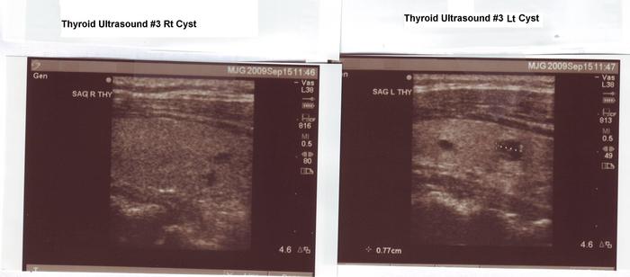 Thyroid Ultrasound Sept 2009