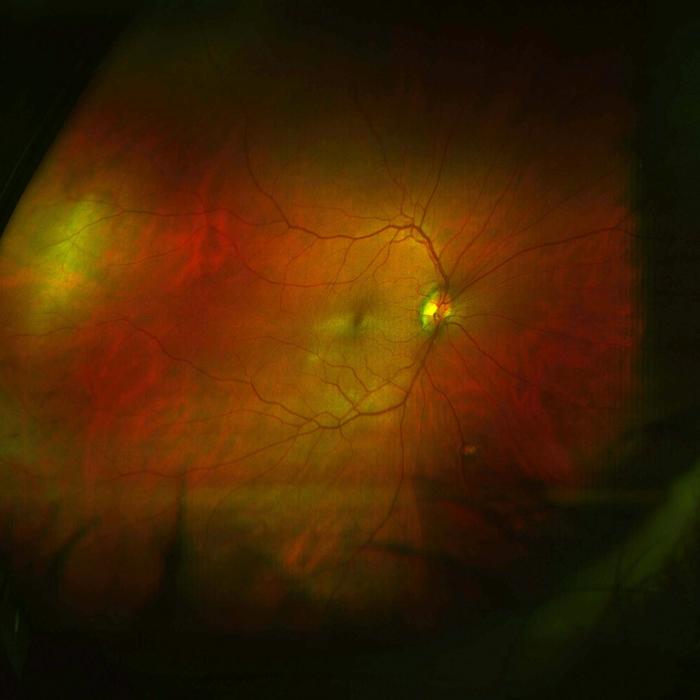 Image of right retina