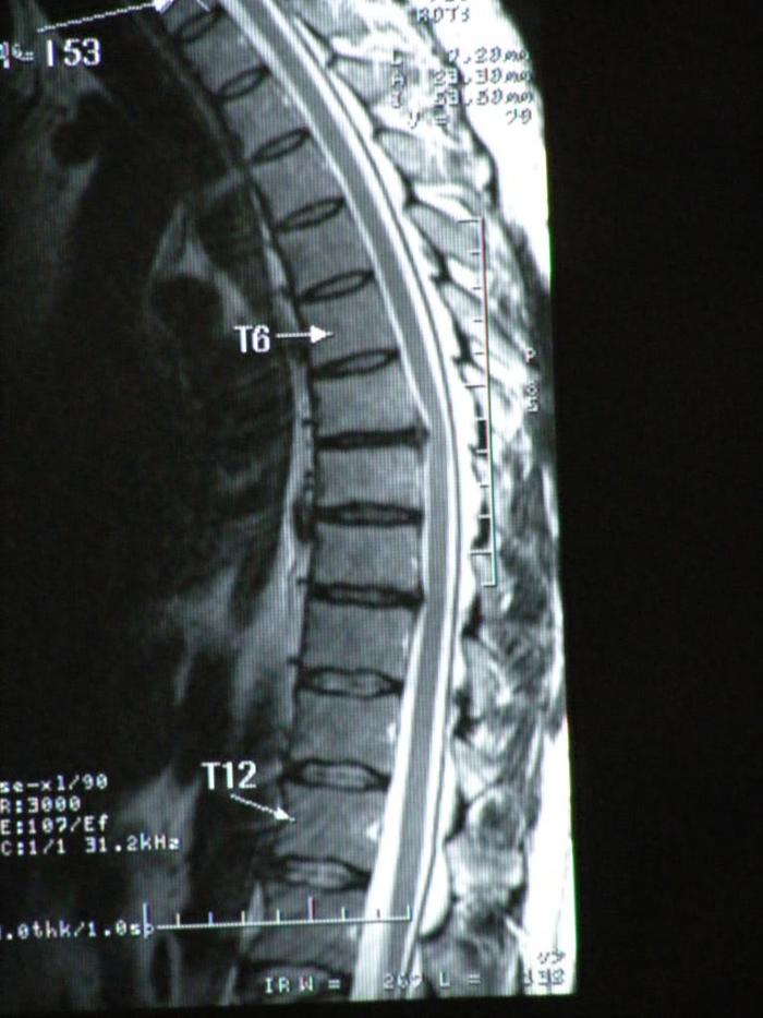 My Back MRI 3