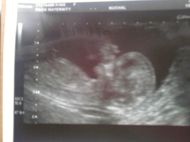 12 weeks ultrasound baby waved 
