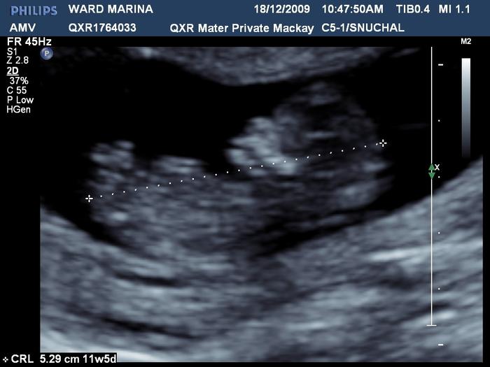 Baby Hoad #2 12 weeks 1 day 