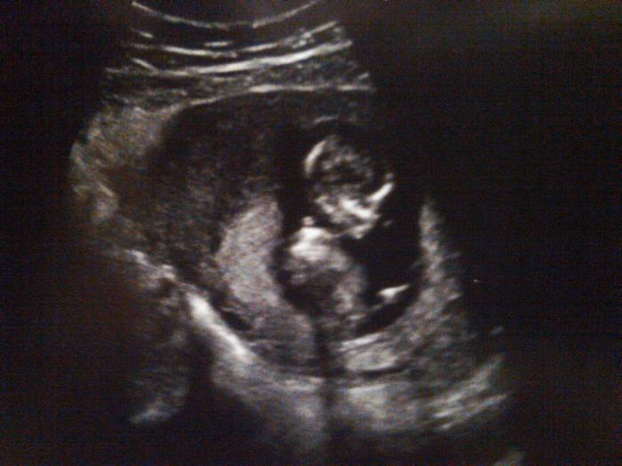 12 weeks 4 days ultrasound