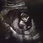 12 weeks 4 days ultrasound