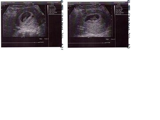 Twin Left & Twin Right Surrogate journey no.1 first u/s 6weeks post transfer
