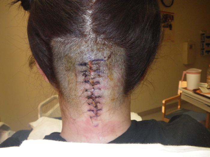 Day 5 post op, had to get more sutures but it didn't even hurt!