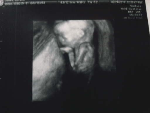 My babypooh @ 18 weeks 4 days...our precious little girl!