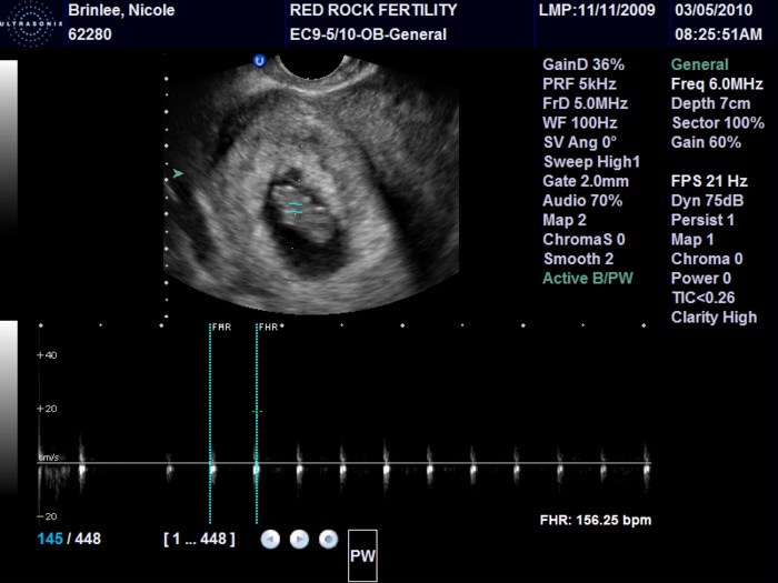 Baby's heartbeat 154 bpm