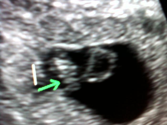 Baby Ferguson @ 6 weeks 3 days (the arrow is the baby the other ball is the cyst)