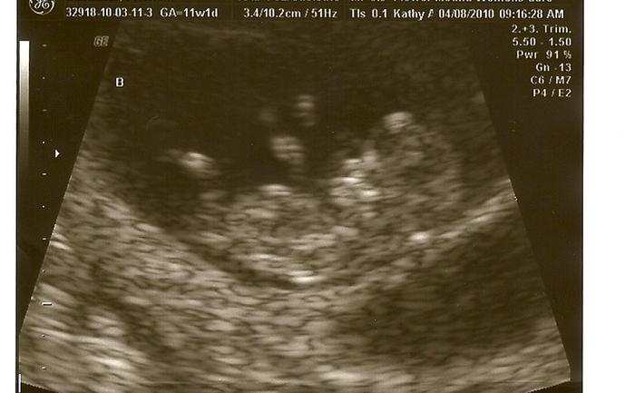 Baby B at 12 weeks