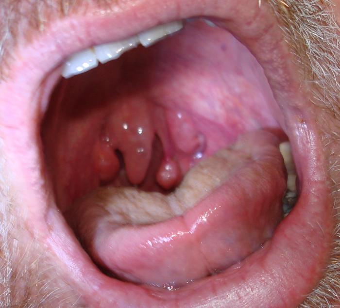 Hanging from left Tonsil 3/10 