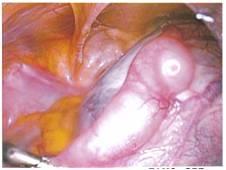 fallopian tube above cyst