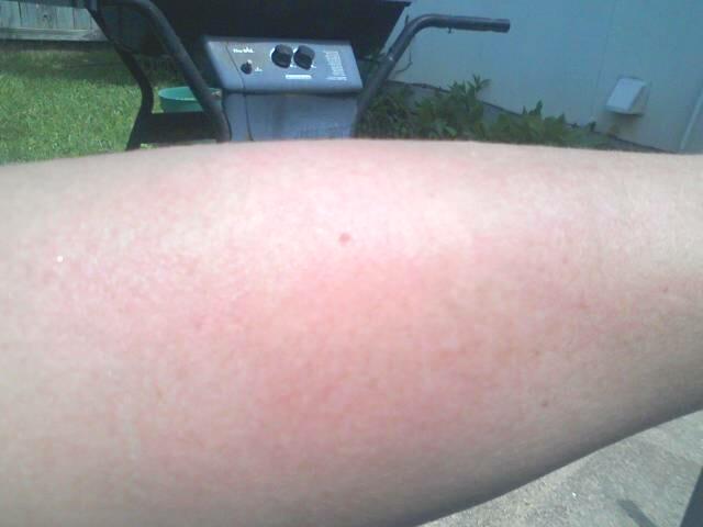 My arm 3 mins after being in sun....