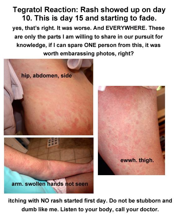 Tegratol Allergy: Rash over entire body