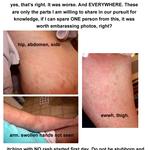 Tegratol Allergy: Rash over entire body