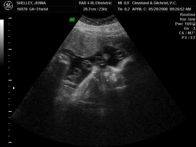 ultrasound 05/12/2008 Sophie DD