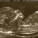 His ferternal twin Baby A at 14 weeks this u/s was also on 4/23/2010 !!!