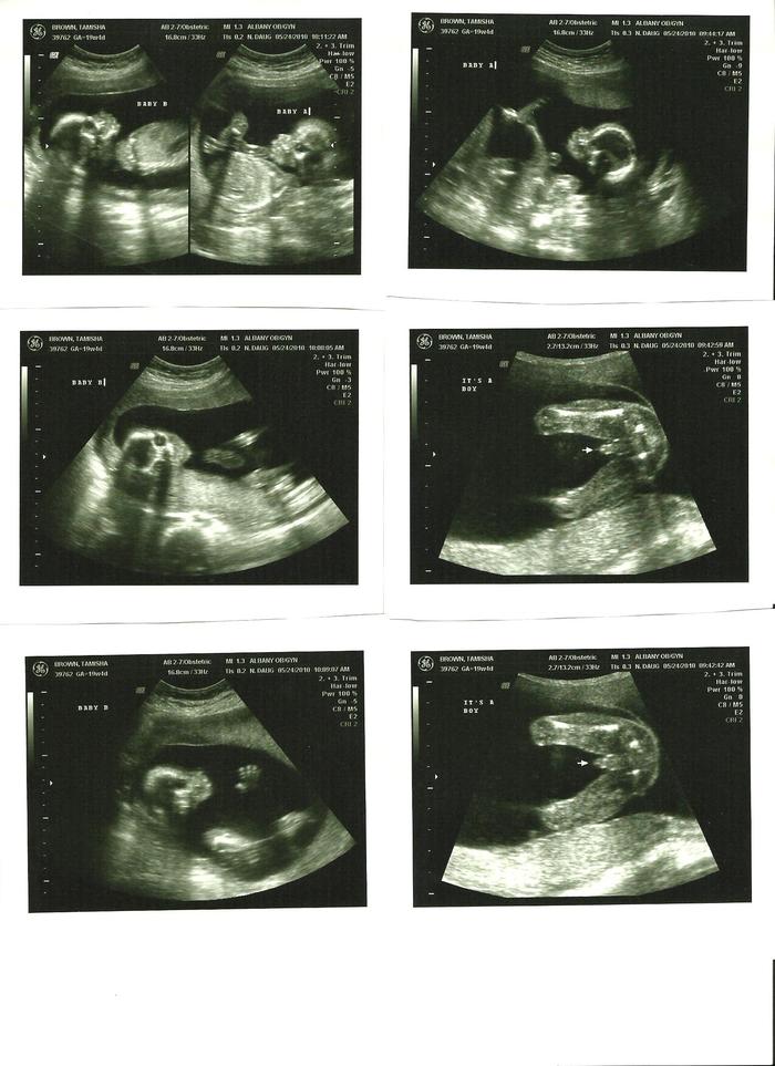 Pics from 5/24/2010 Ultrasound
