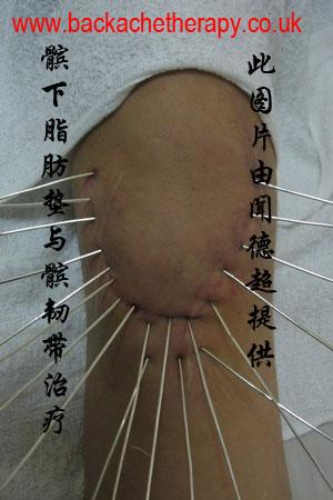 silver acupuncture in China