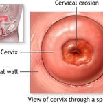 cervical erosion