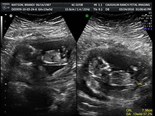 Baby's Crown To Rump Length = 7.36cm
13 weeks and 3 days