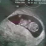First real Ultrasound at 9 weeks