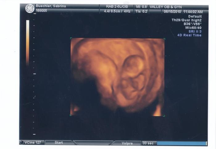 3D Ultrasound 10wks 4 days